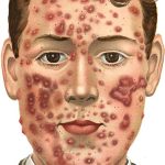 How To Take Care Of Blackheads.
